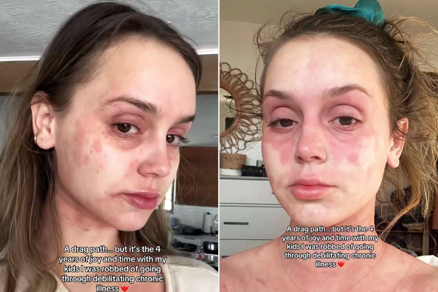 Mikayla Matthews slams people online for 'minimizing' her chronic skin ...