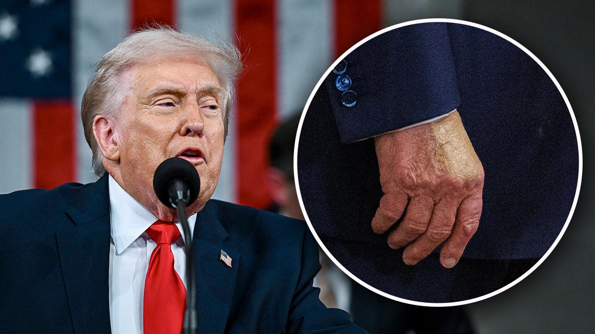 Donald Trump slathers makeup on his swollen hand for graduation address ...