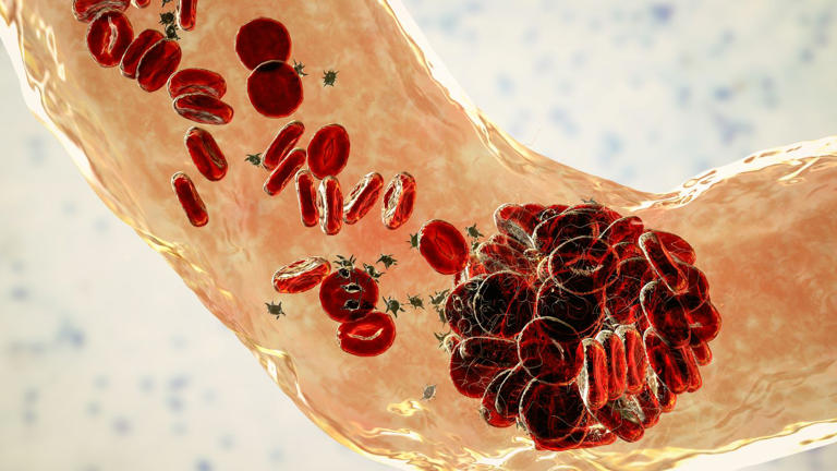 Jupiter Endovascular’s pulmonary embolectomy system hits primary ...