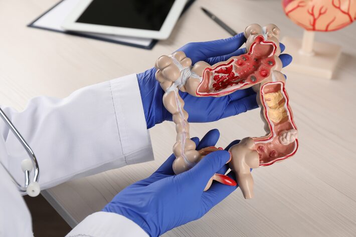Câncer de intestino: quem deve fazer o teste imunoquímico fecal? Como ...