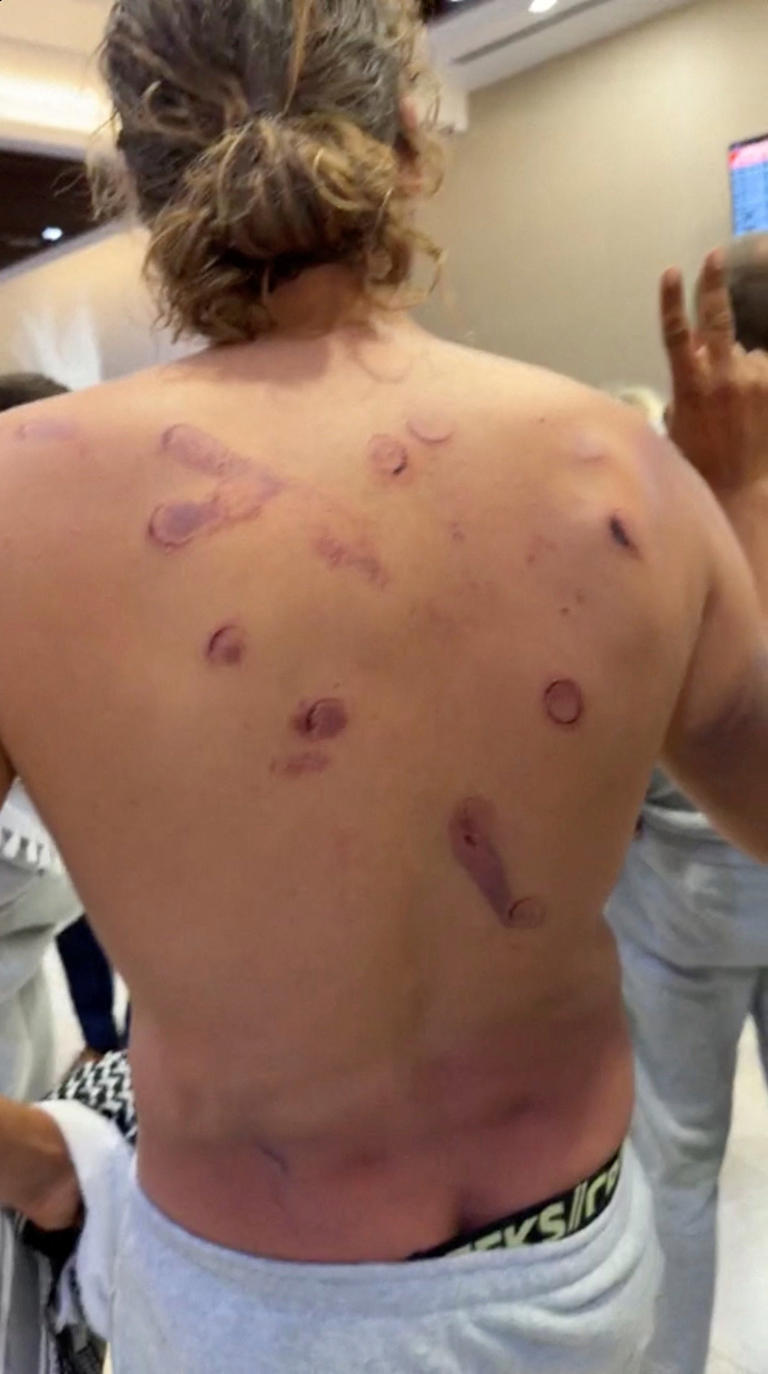 French national Adrien Jouan shows injuries to his back (Reuters)