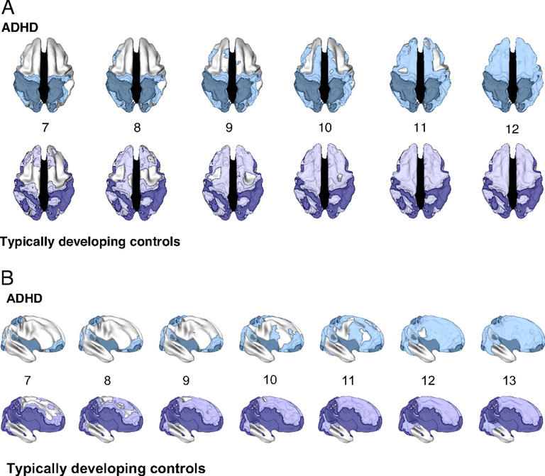 Signature of ADHD in the brain may be a mirage, study suggests