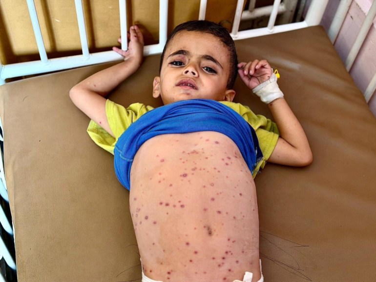Burn-like rashes and hunger: Gaza’s children face skin disease crisis