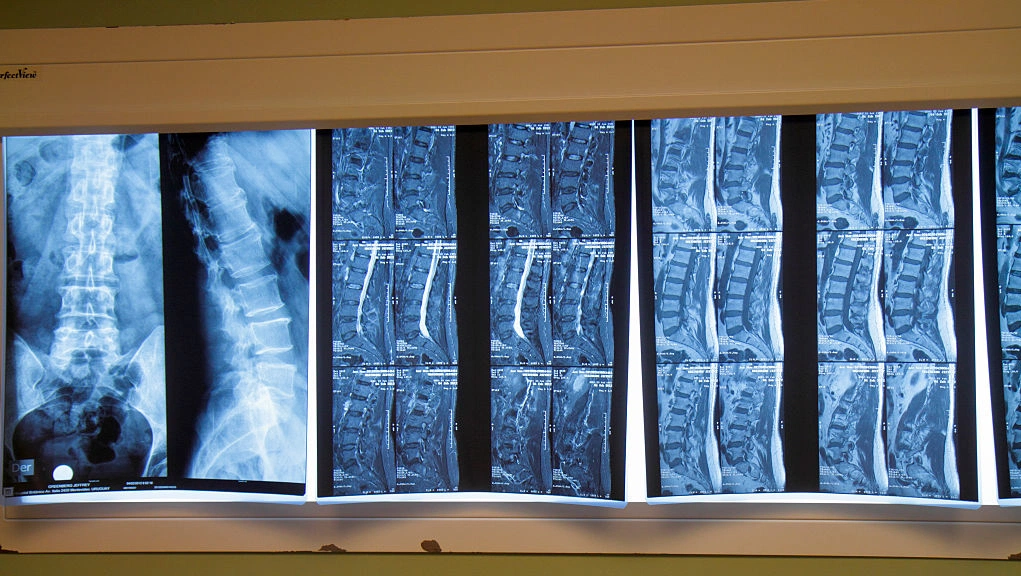 Living better with pinched nerves and radiculopathy