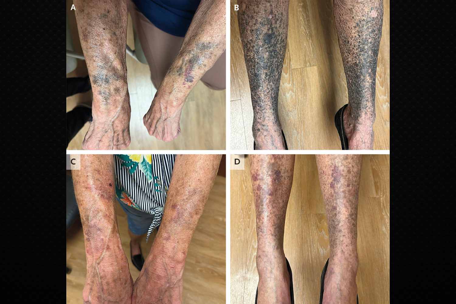Prende l’antibiotico per la rosacea e si riempre di macchie blu: lo ...