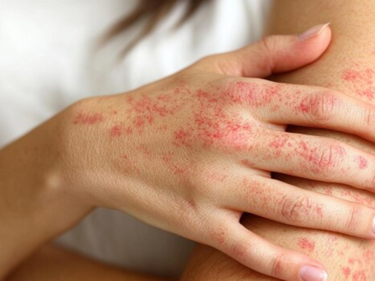 Beat the heat rash: What every woman needs to know about summer skin ...