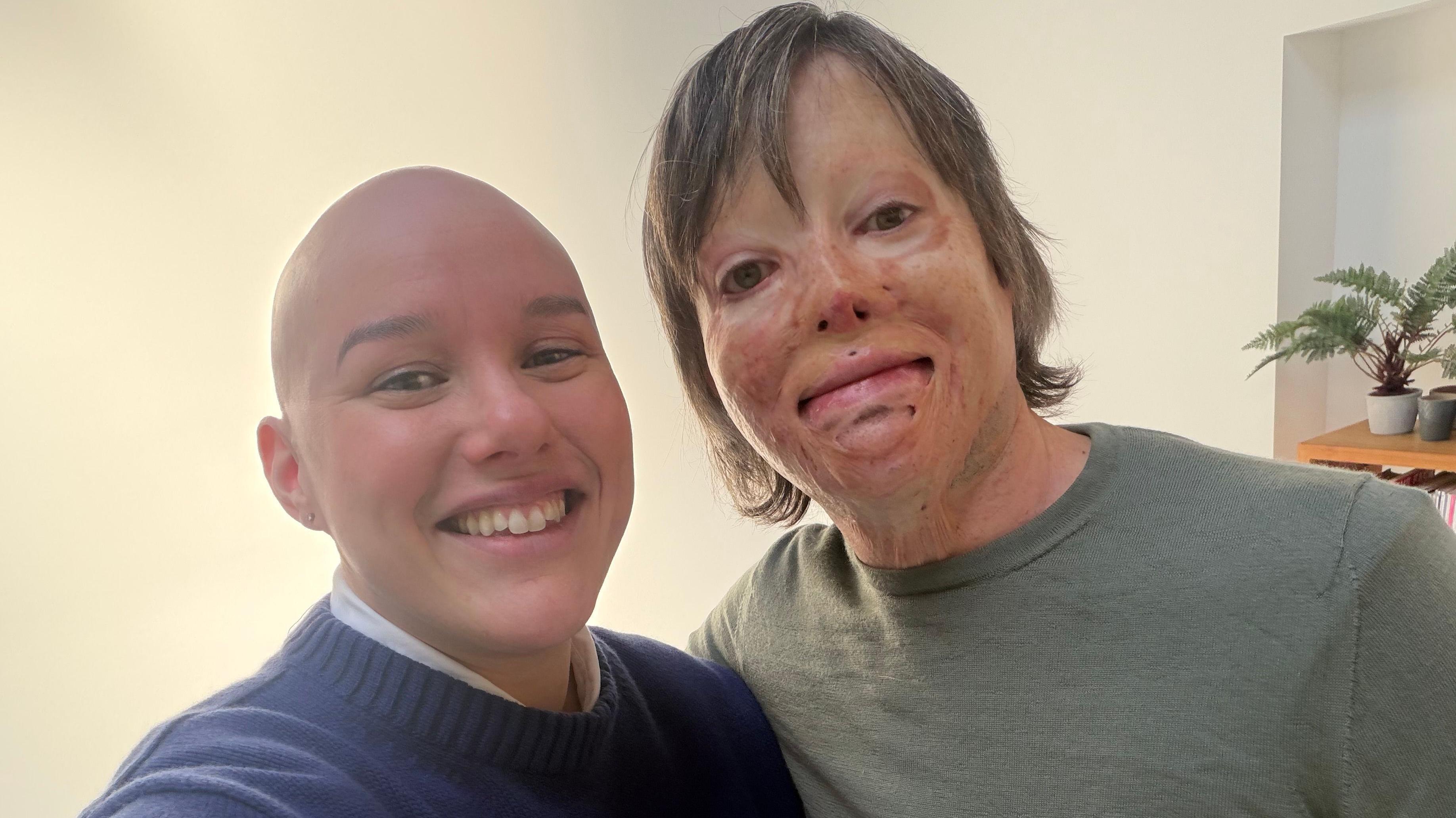 'I have alopecia but he asked if I was dressed as Pitbull'