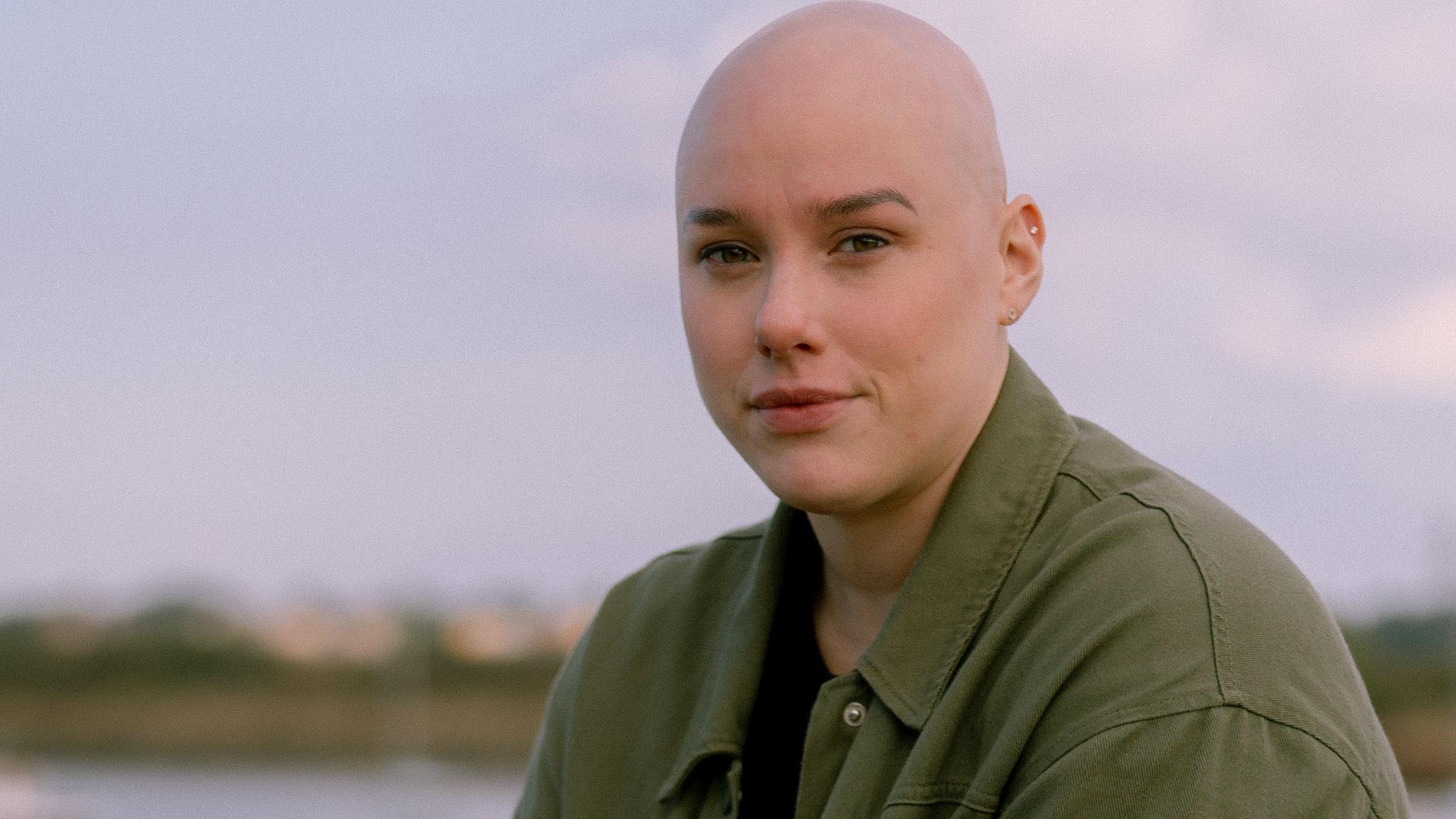 'I have alopecia but he asked if I was dressed as Pitbull'