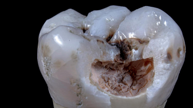 Scientists just linked deep tooth infections to high blood sugar ...