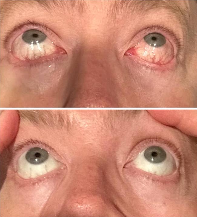 Close-up of eyes looking upwards, showing differences in eyelid position, possibly related to a cosmetic or health product context