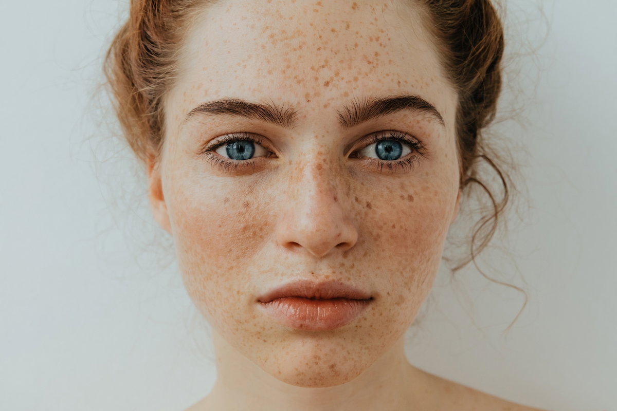 Xeroderma pigmentoso: o que é, sintomas, causas e tratamento