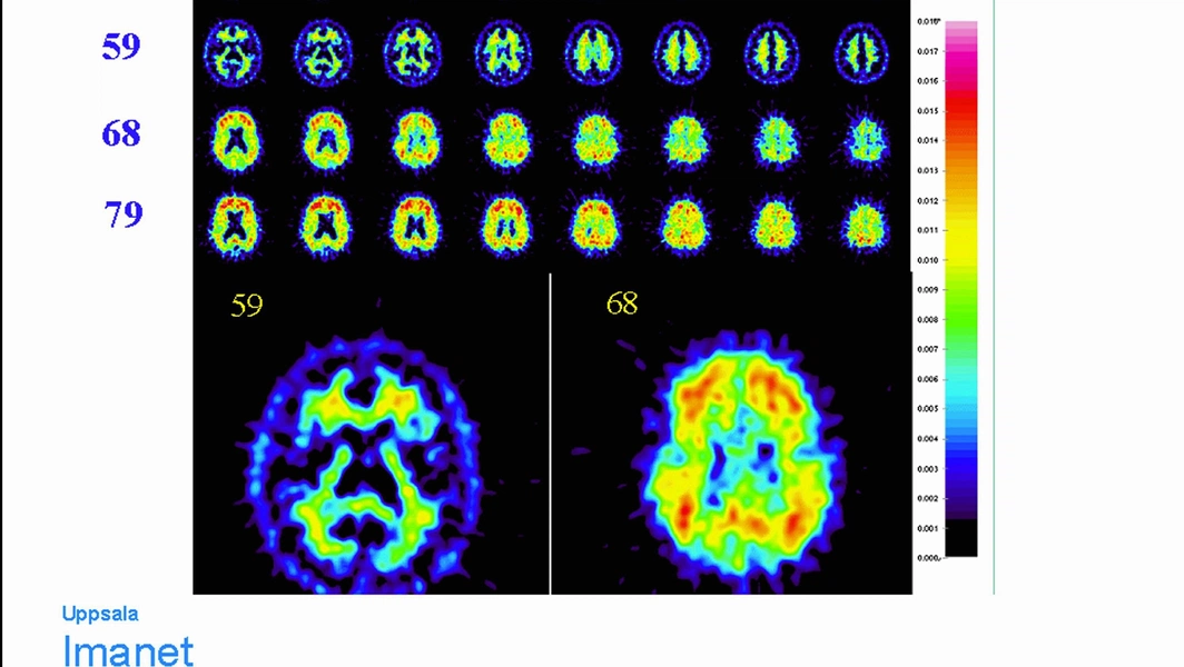 Study finds math method inflated Alzheimer’s drug benefits by 29x