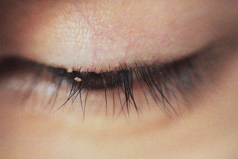 Irritated eyes? Tiny mites living in your lashes could be why