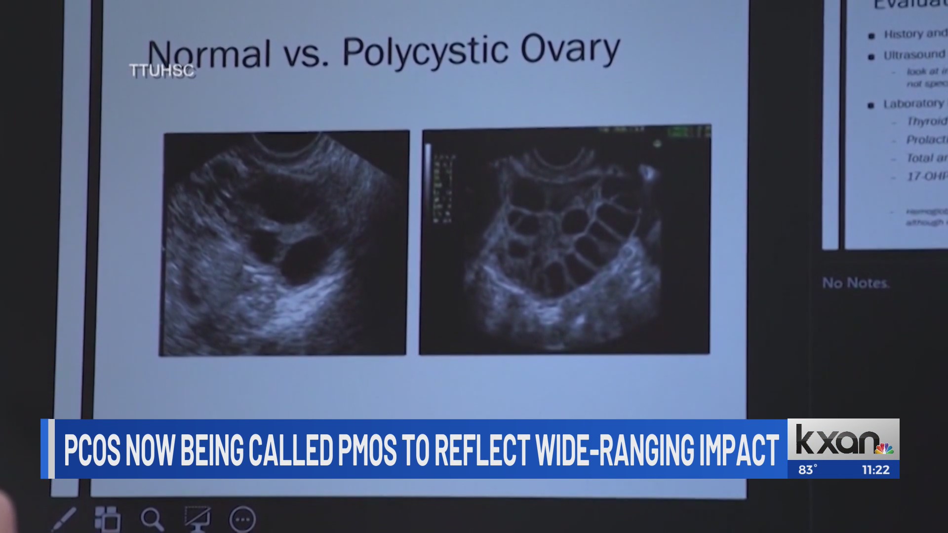 PCOS renamed PMOS to reflect wide-ranging impact