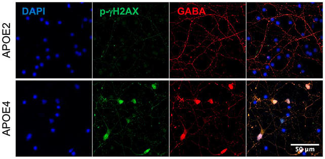 This gene is linked to lower Alzheimer's risk – and we may finally know why