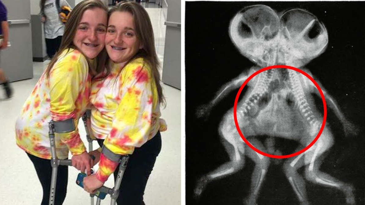 Formerly conjoined twins finally share their journey 18 years after ...