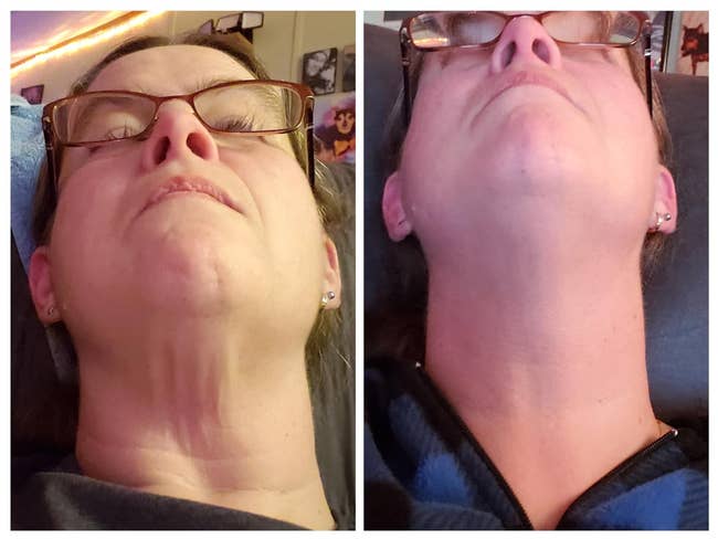 Close-up of a person shown side-by-side, illustrating a before-and-after skin treatment on the neck area