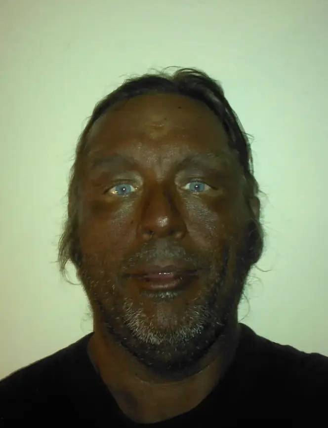Dermatologist explains what happens to your body after you take Melanotan II