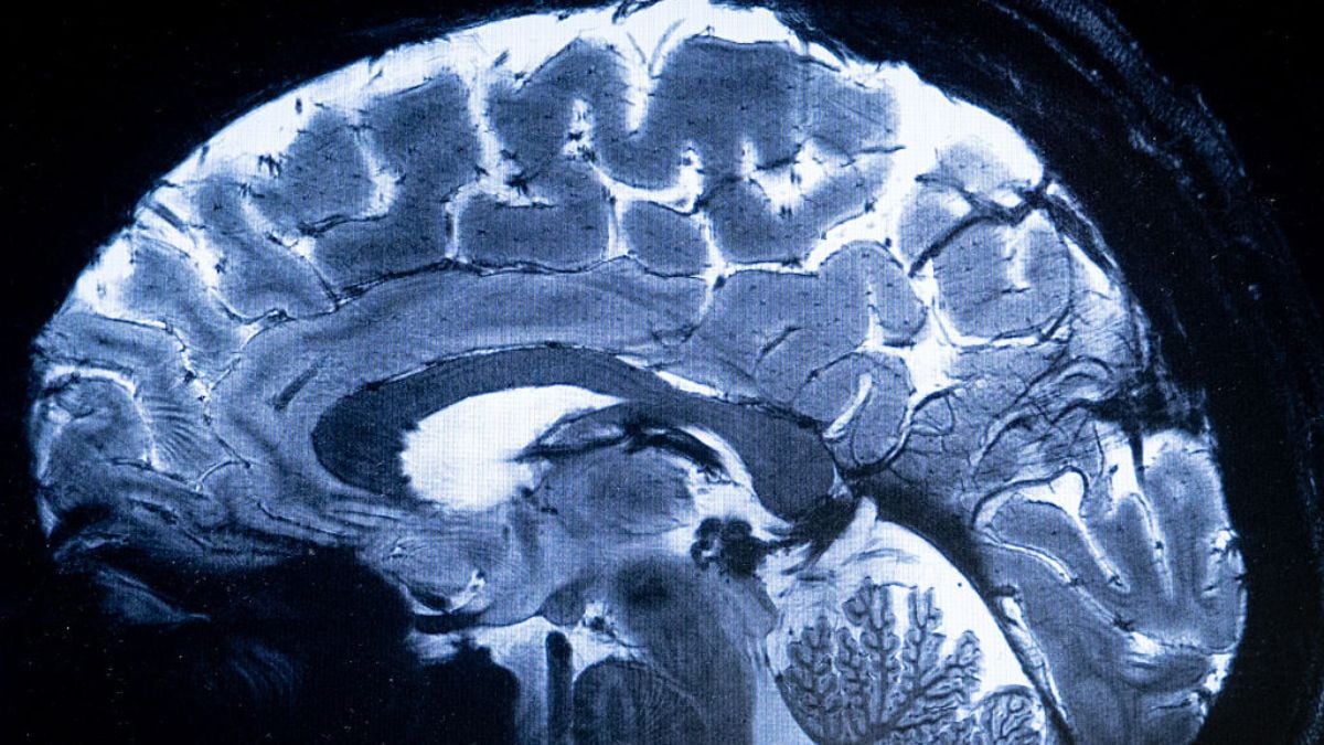 Experimental brain 'pacemakers' may rewire circuits linked to depression