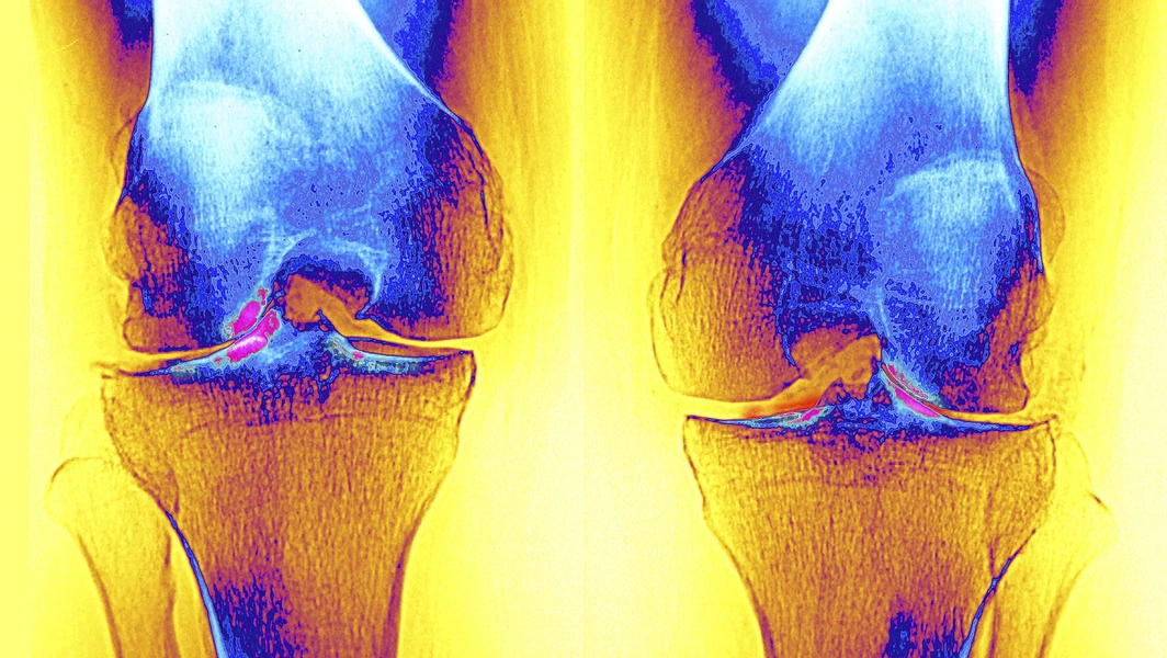 GLP-1 drugs linked to reduced knee replacement need