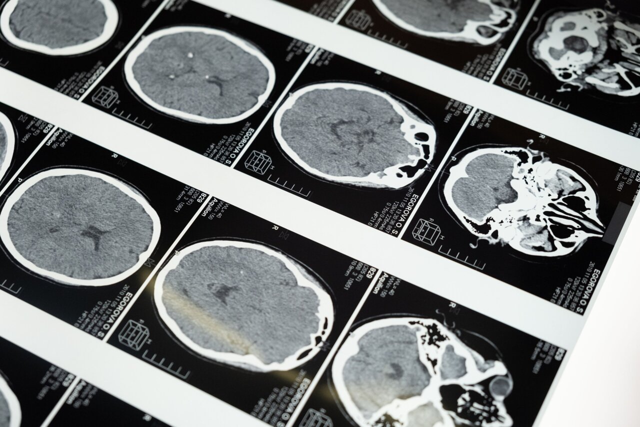 How blocking immune cell signals could make brain tumors easier to remove