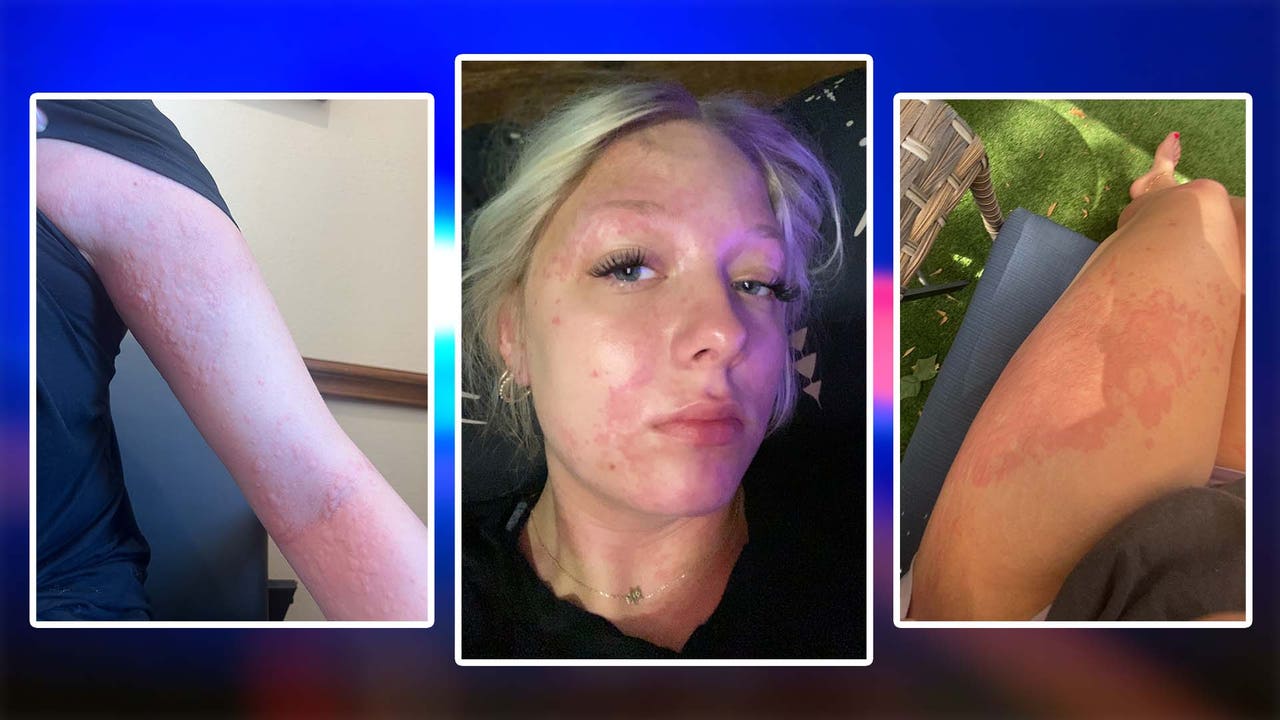 Trinidad family says daughter suffered chemical burn after showering ...