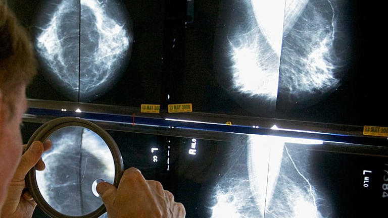 FILE - A radiologist uses a magnifying glass to examine mammograms for signs of breast cancer in Los Angeles on 6 May 2010. (AP Photo/Damian Dovarganes, File)
