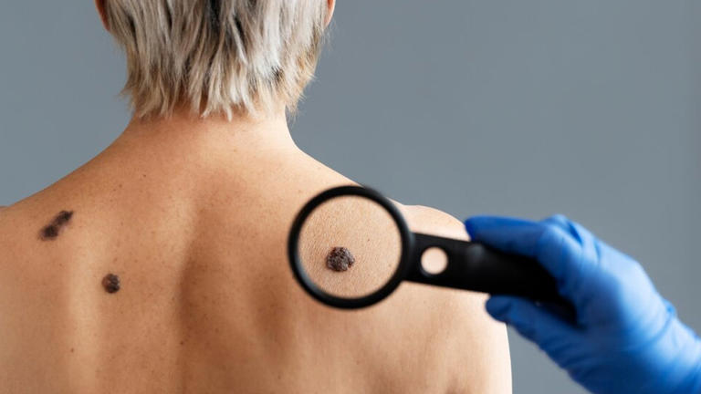 Types of skin moles and when to worry: Dermatologist shares warning signs