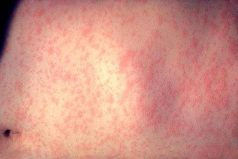 Erie County says measles case confirmed