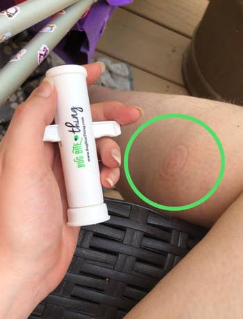 Reviewer holding Bug Bite Thing with their leg in the background showing a ring where they suctioned out a bug bite