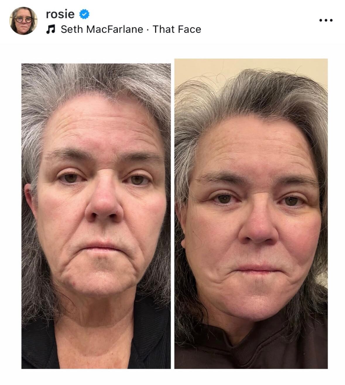 On Wednesday, Rosie O'Donnell published her before-and-after photos on Instagram. / Instagram/Rosie O'Donnell