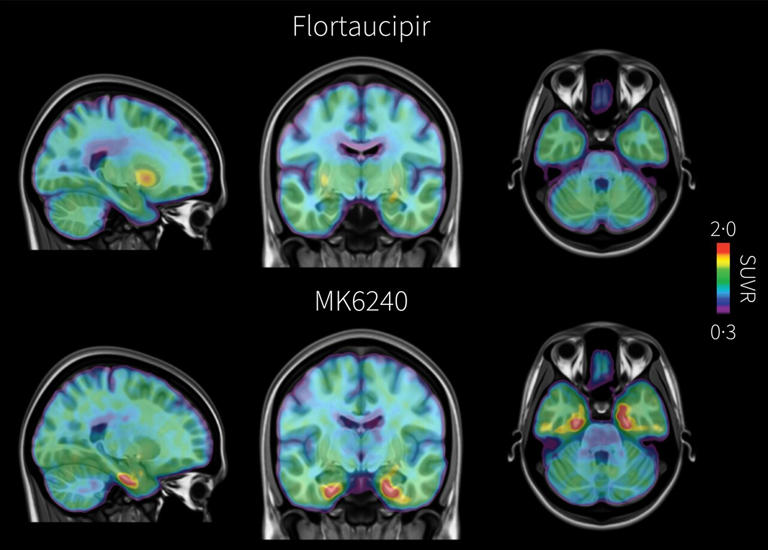 New brain scan detects Alzheimer's tau earlier than current standard