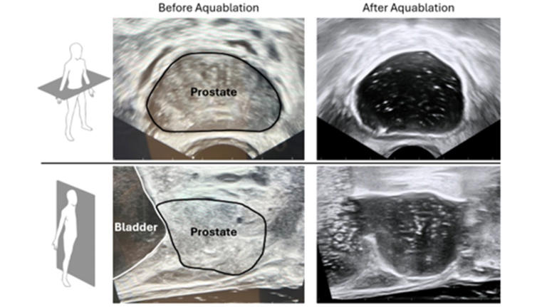 Procept secures FDA IDE for Aquablation and completes WATER IV study ...