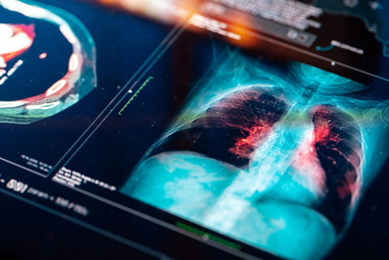 Akeso lung cancer drug improved survival, challenging standard treatment