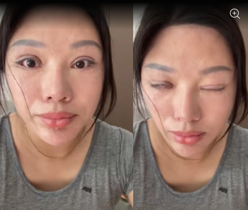 6 năm không thể nhắm mắt vì cắt mí