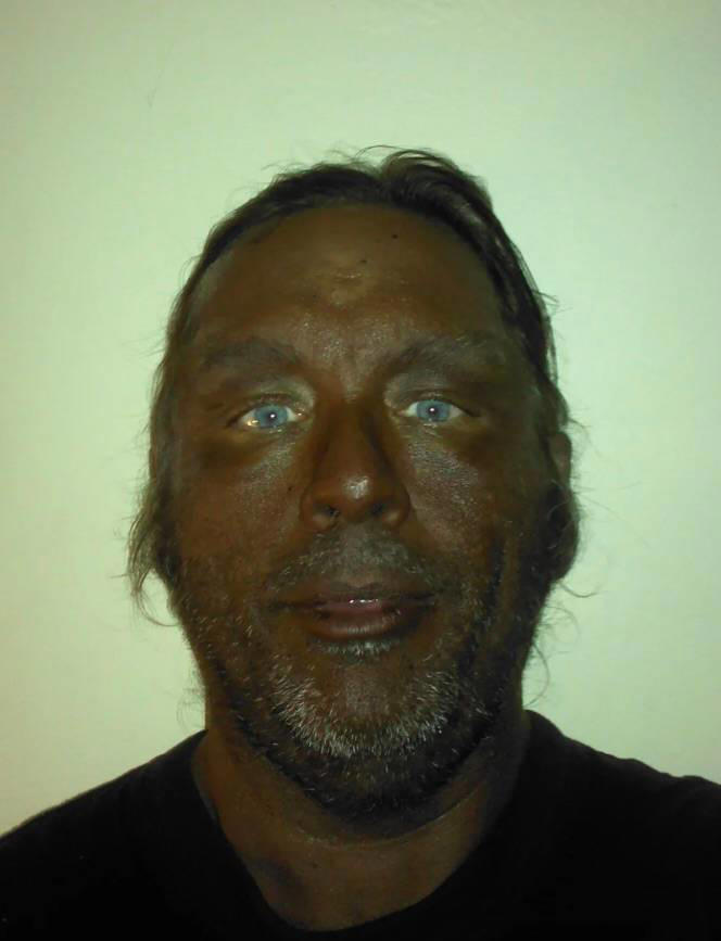 side effects of melanotan ii My first media interview about the dangers (tanning peptide) was 13 years ago. I discuss this again with @abcnews_au here. Thank you Dr @timpiatkowski for sharing your research insights Man who spent three months