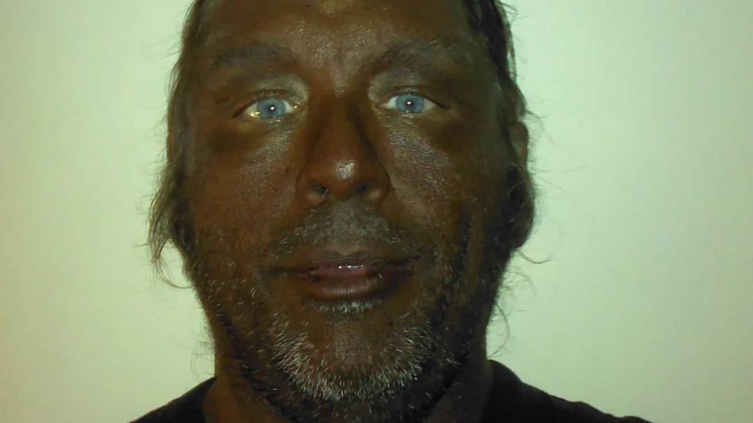 Dermatologist explains what happens to your body after you take Melanotan II