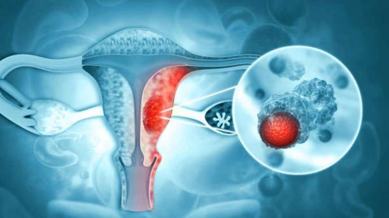 India's first indigenous HPV test validated to make cervical cancer ...