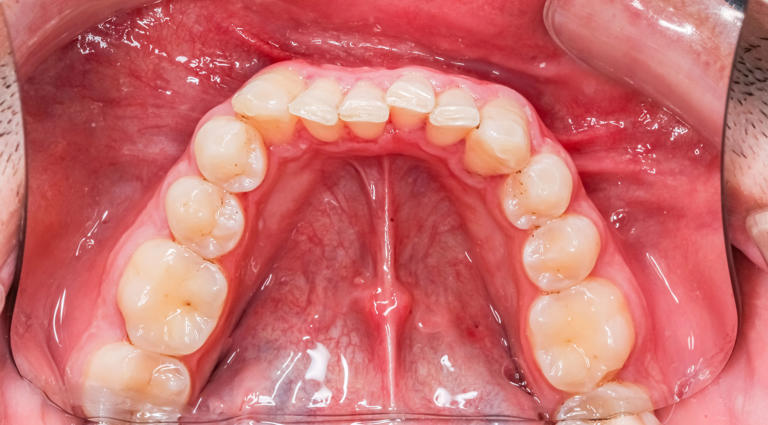 If you're a coffee drinker, your tooth brushing might be eroding your ...