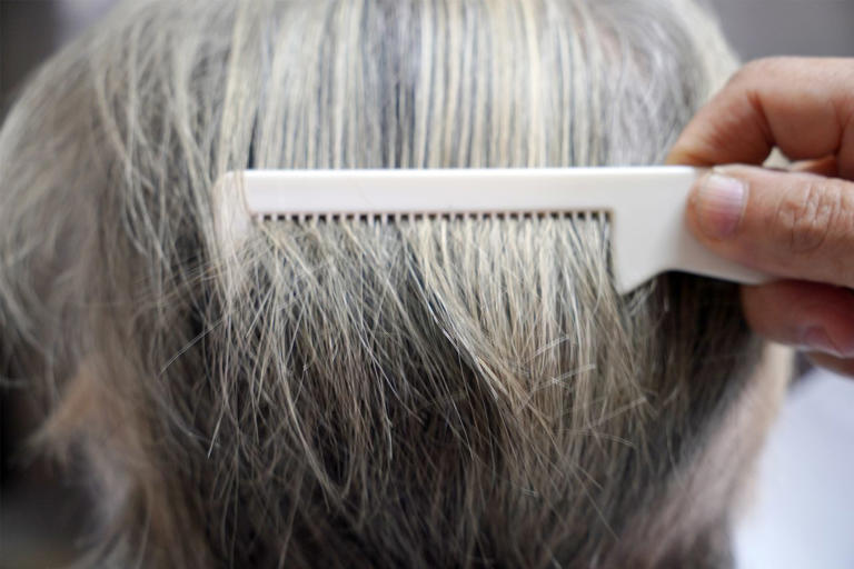 melanotan 2 grey hair 50 Weeks on Melanotan2. Used to be Type 1 and never able to tan. Have never felt better! Beard color change is epic : r/Melanotan2 REGENSIFY Hair Melanin Booster Anti
