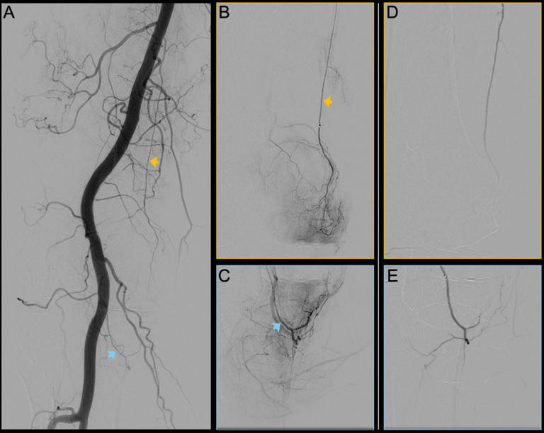New non-surgical procedure may help relieve knee pain of millions