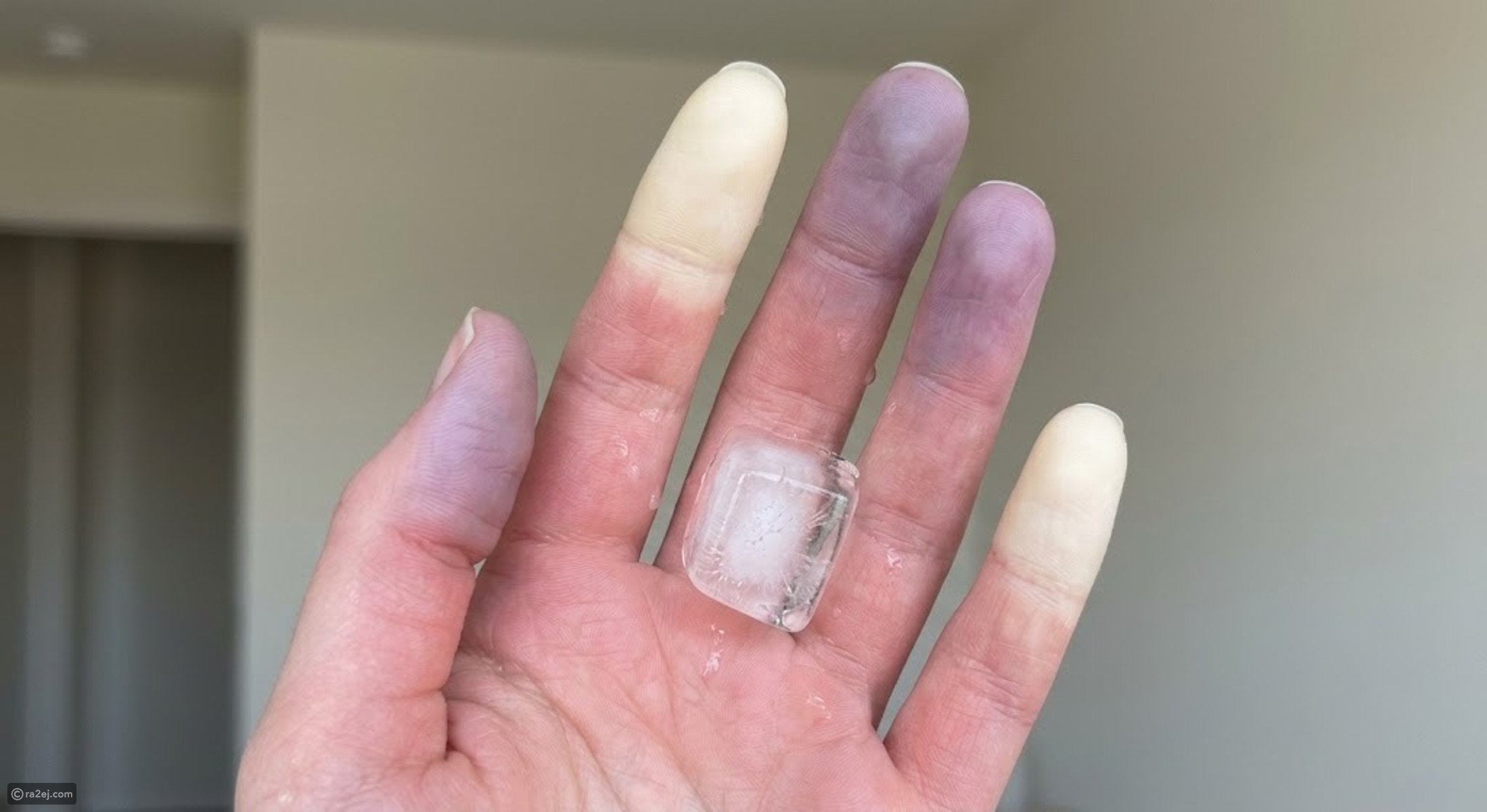 People with cold hands and one other symptom urged to see a doctor