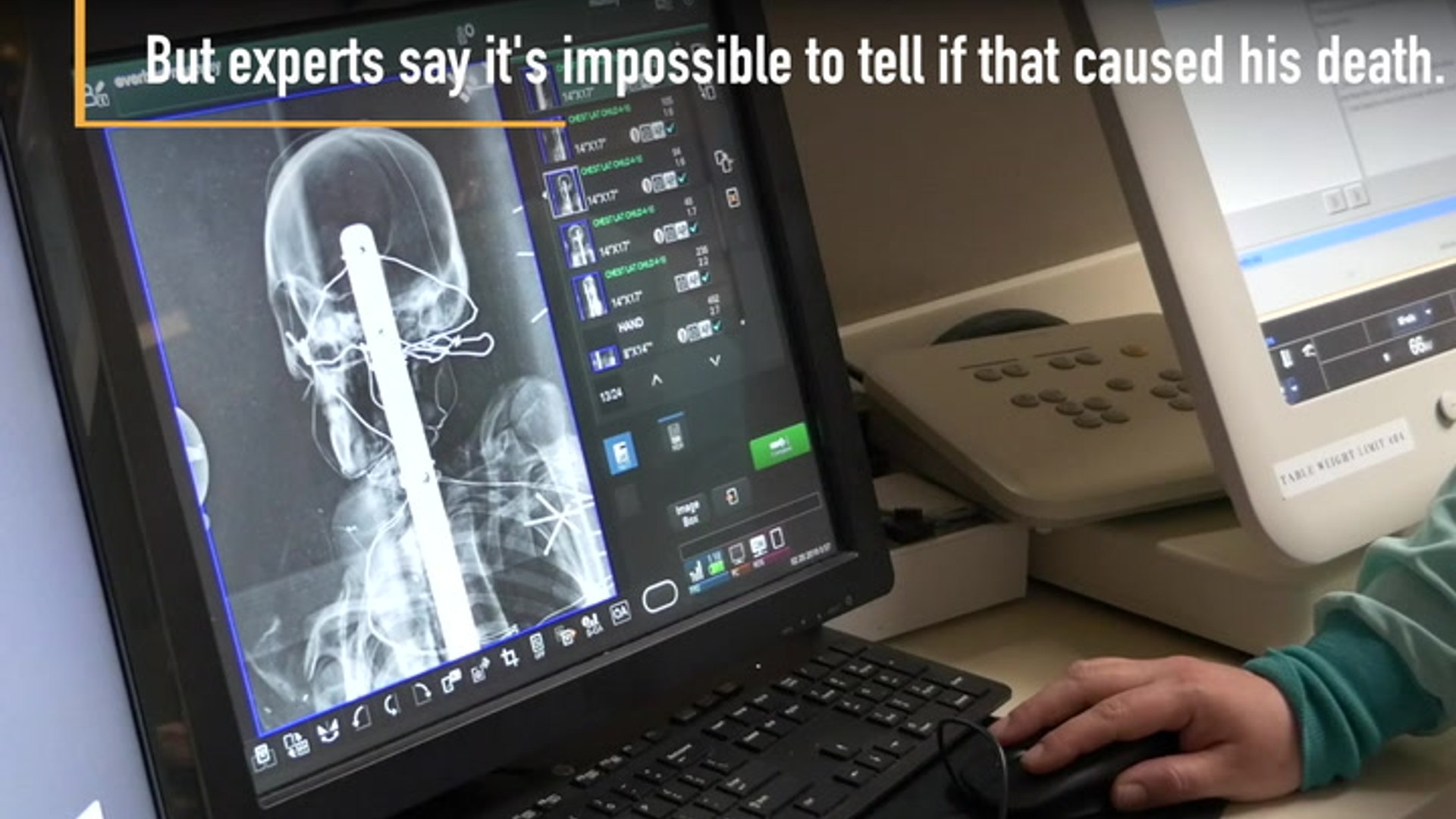 X-rays reveal mummy was a teenager