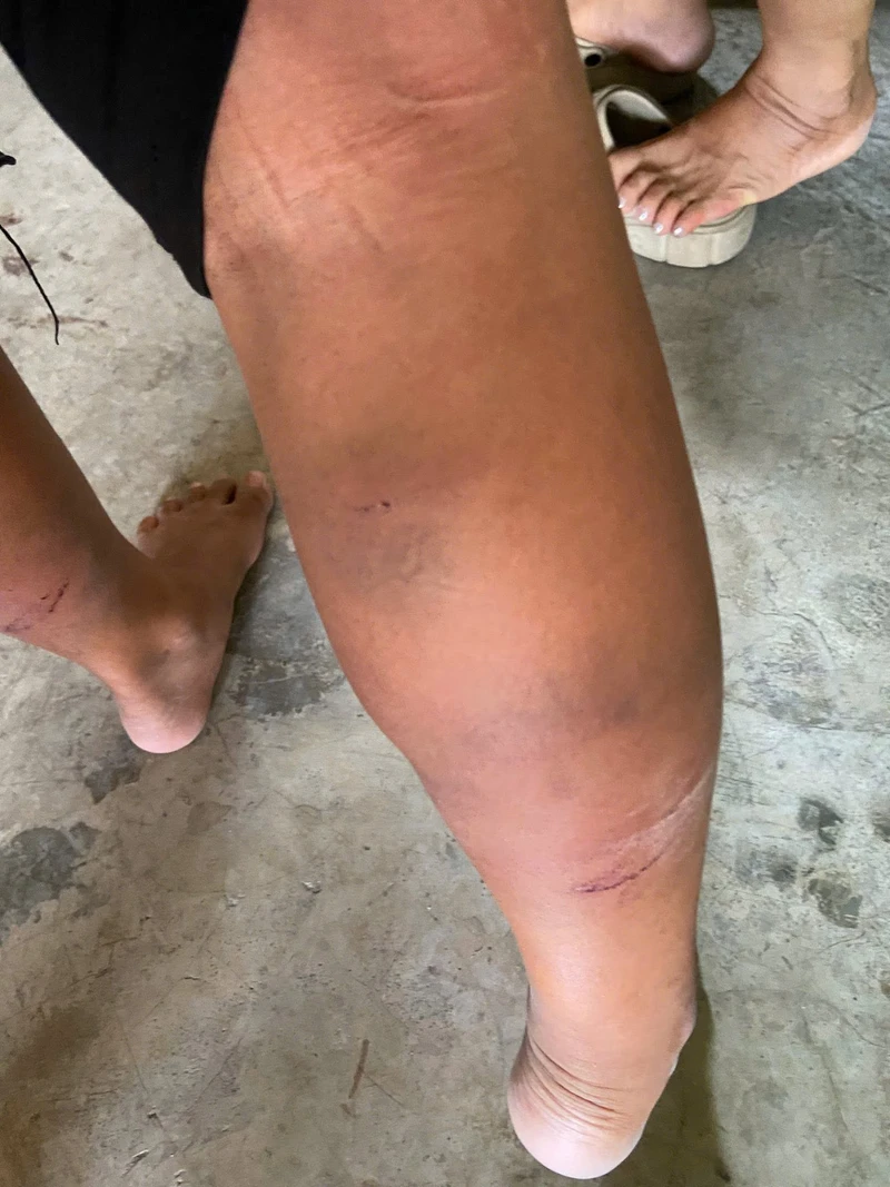 Công an vào cuộc xác minh vụ cháu bé đầy vết bầm tím trên cơ thể