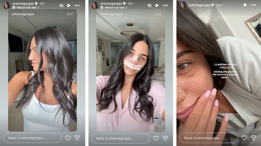 A split of Antonia Gorga pre and post plastic surgery.