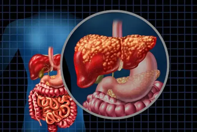 El exceso de ultraprocesados afecta la salud hepática. ISTOCK