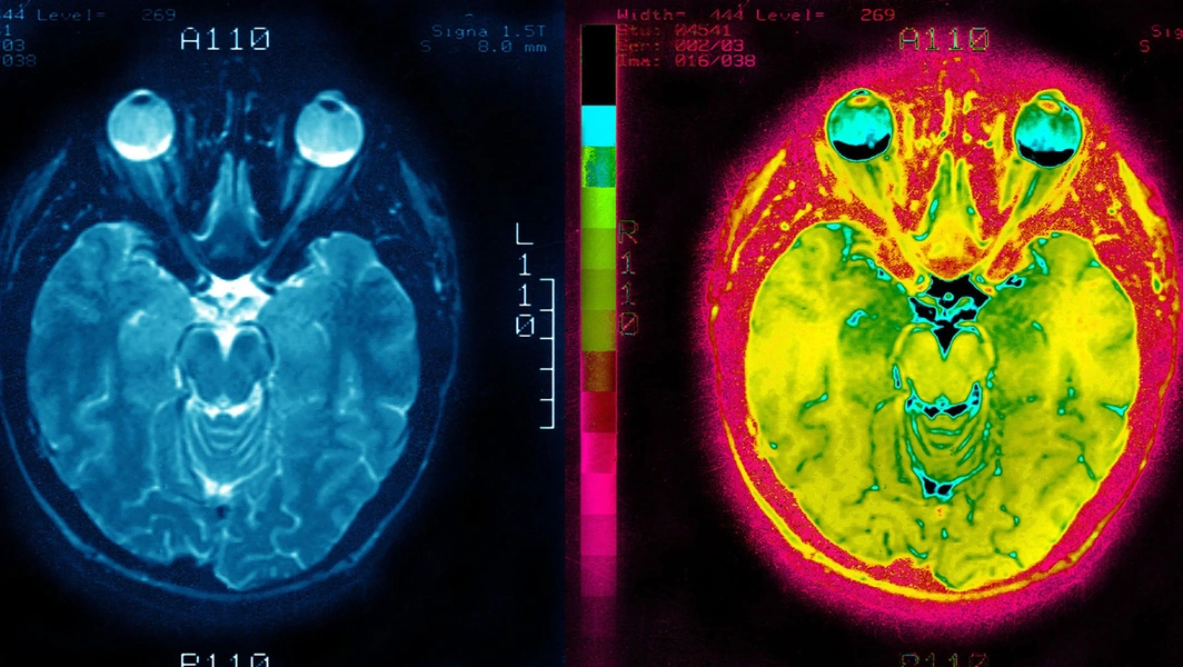 How socioeconomic factors shape child brain development