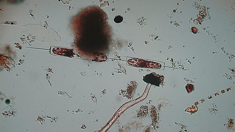 Latest 'flesh-eating bacteria' outbreaks around the world