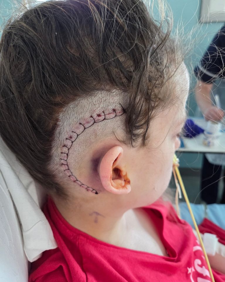 Sophie Martin, in hospital. A woman who thought her loss of hearing was due to playing loud music was shocked to find out it was a symptom of a rare genetic brain tumour. Sophie Martin, 29, noticed her earphones getting quieter but didn’t think much of it until she started to develop tinnitus. In June 2025, five months after her symptoms started, Sophie, from the Lake District, Cumbria, went to see her GP who referred her for a CT scan, which showed a mass on her brain. To her horror, Sophie was diagnosed with neurofibromatosis type 2 (NF2)