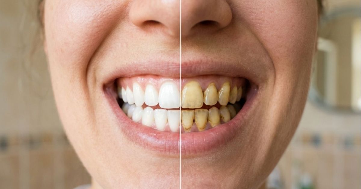 A dentista explica como limpar dentes amarelados de forma eficaz ...